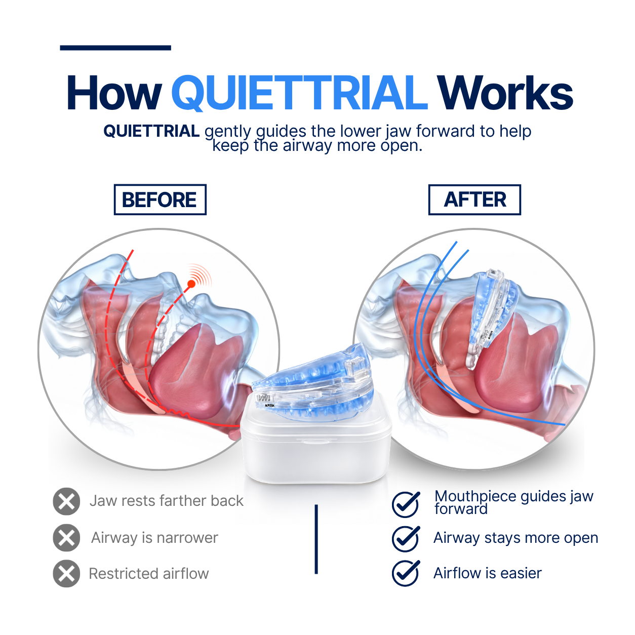 Quiettrial Pro ® Mouthpiece - Stop Snoring First Night