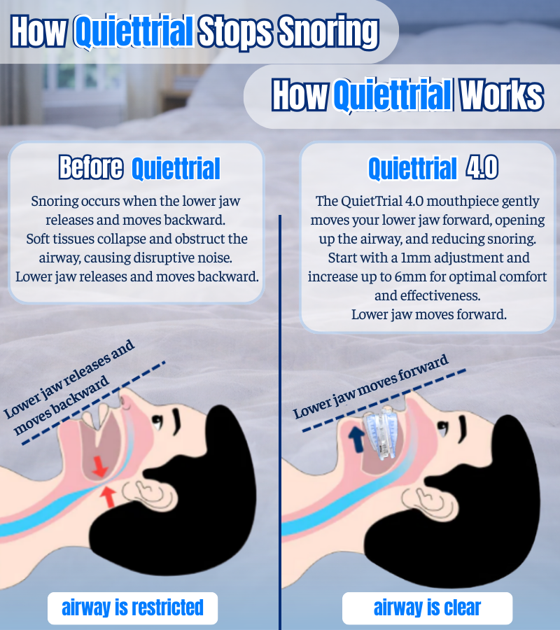 QuietTrial Plus+ Anti-Snoring Mouthpiece